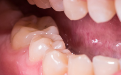 Gestion symbolique et énergétique de la douleur liée à la perte des prémolaires en orthodontie