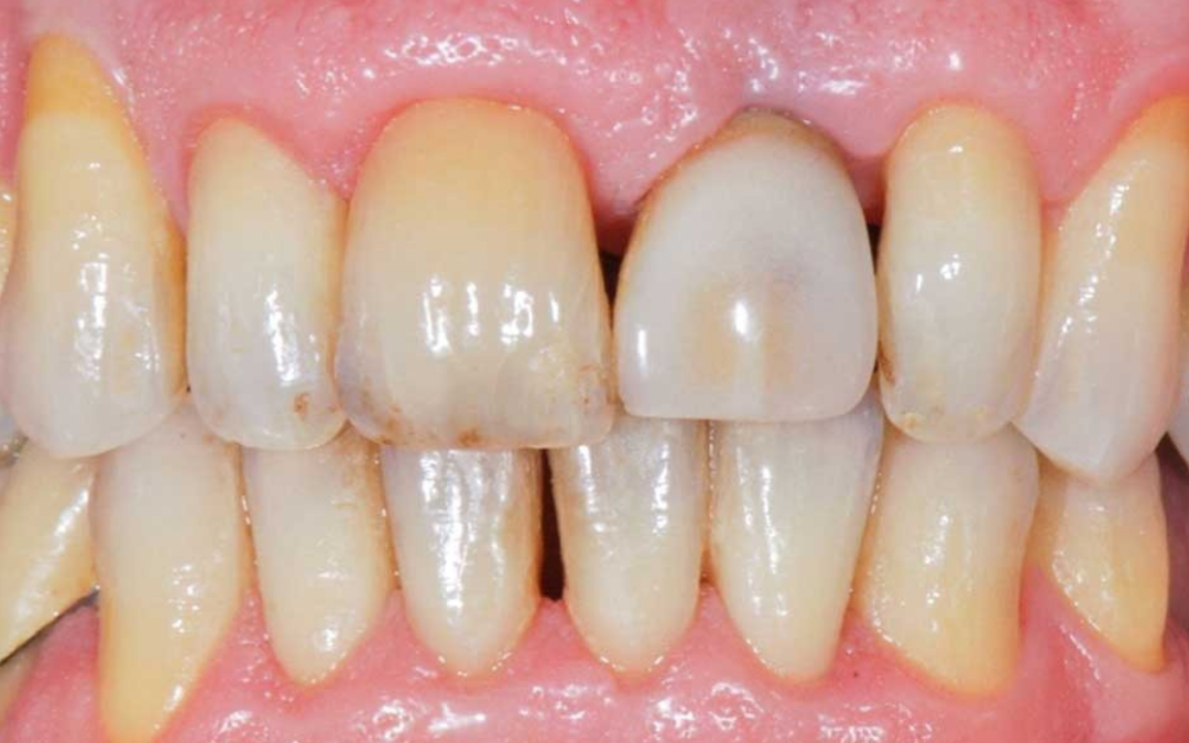 Congrès parodontite et gestion de la douleur : comment sécuriser scientifiquement votre pratique et gagner en efficacité clinique